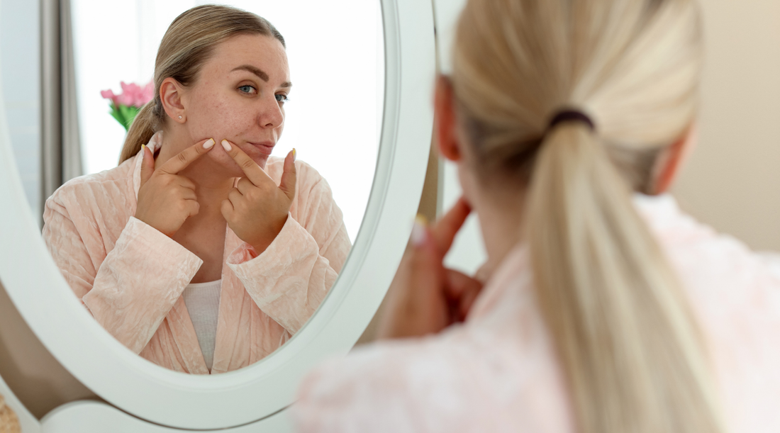 How To Get Treatment for Acne as an Adult: Online Options and What to Expect