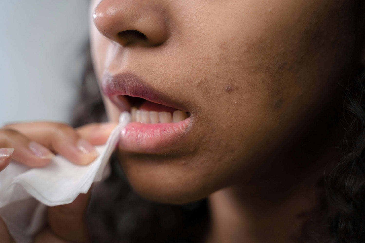 Cold Sores
