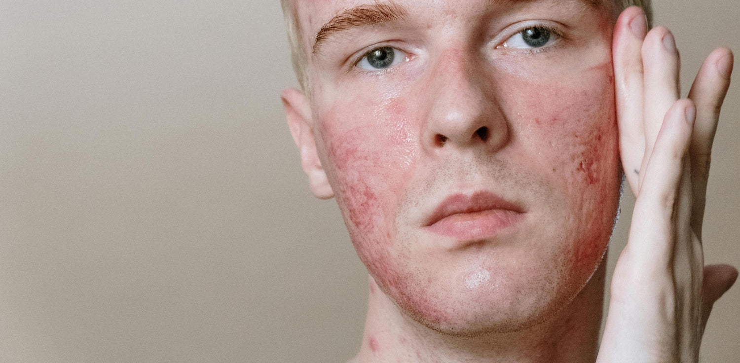 Rosacea