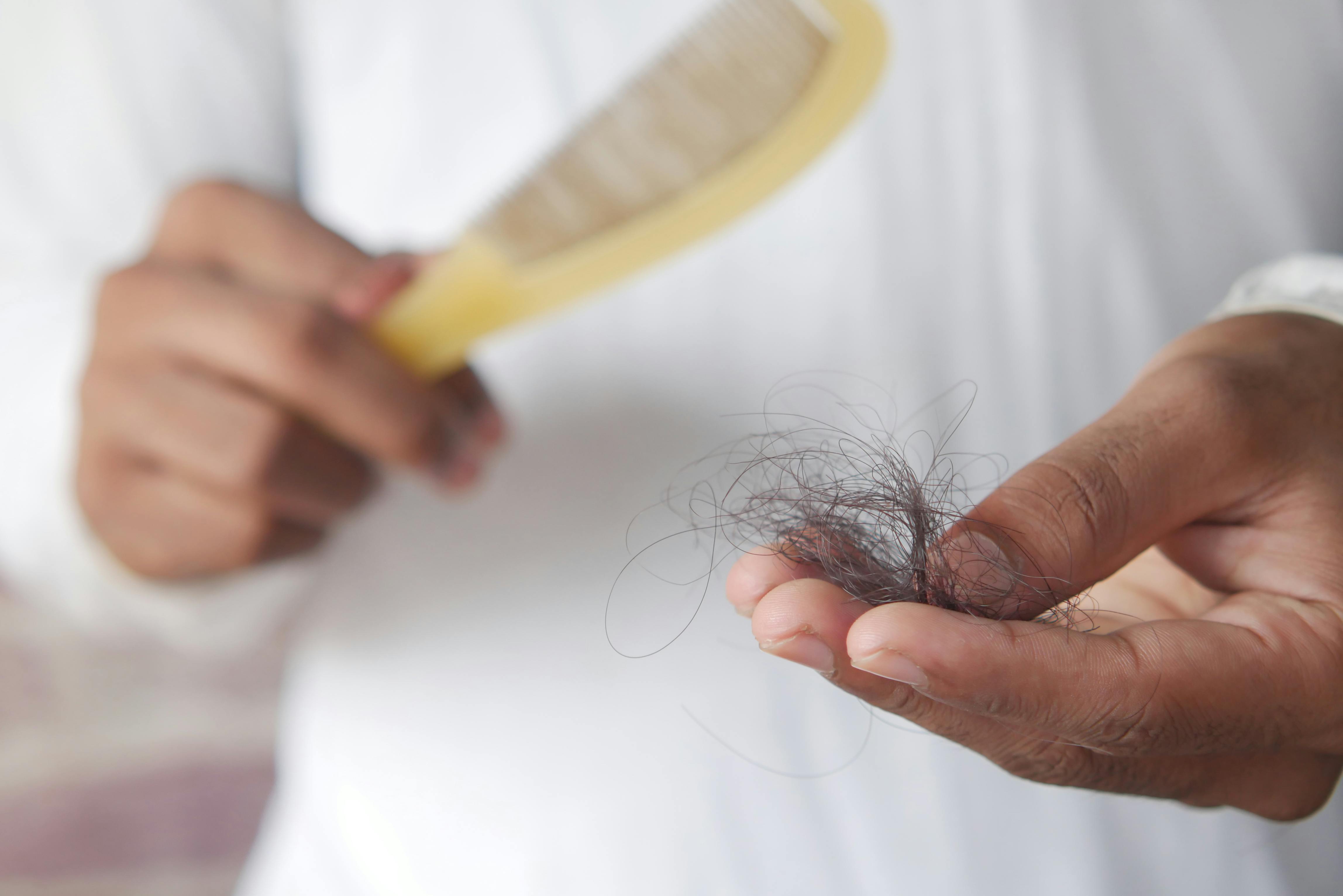 Male Hair Loss